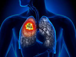 Importancia de mantener tratamiento para cáncer de pulmón durante pandemia  de COVID-19