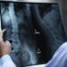 A doctor with a patient's x-ray film
