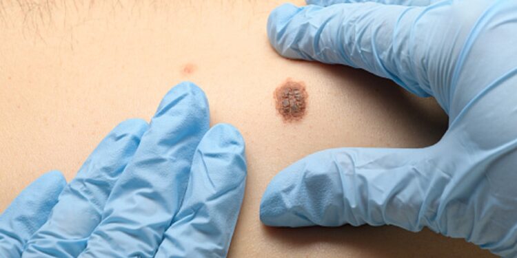 Visual examination of the mole for the presence of malignant neoplasms. Prevention for detecting skin cancer and melanoma.