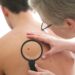 Dermatologist examines a mole of male patient