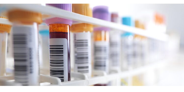Blood samples in a test tube rack.