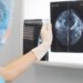 woman doctor or nurse in surgery outfit is holding a mammogram in front of x-ray illuminator