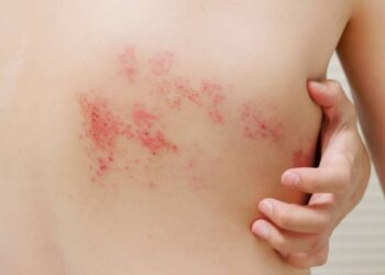 herpes