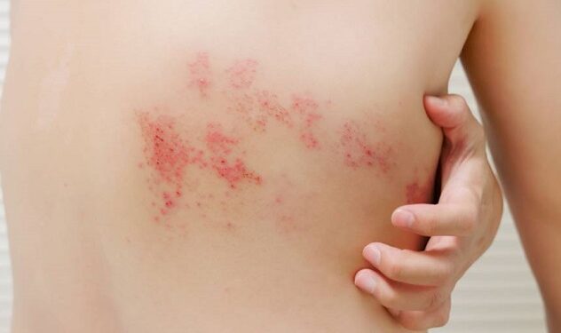 herpes